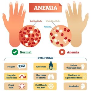 Iron Deficiency Anaemia के 5 छिपे संकेत: डॉक्टर्स के अनुसार, ये 8 फूड्स सबसे तेज़ आयरन बढ़ाते हैं 6 Iron Deficiency
